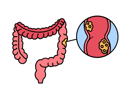 Metastasierter Darmkrebs: Was bedeutet diese Diagnose?