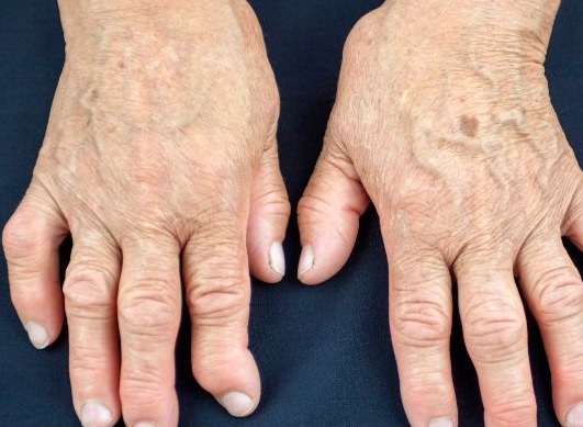 Warum belastet die rheumatoide Arthritis den Körper so sehr?