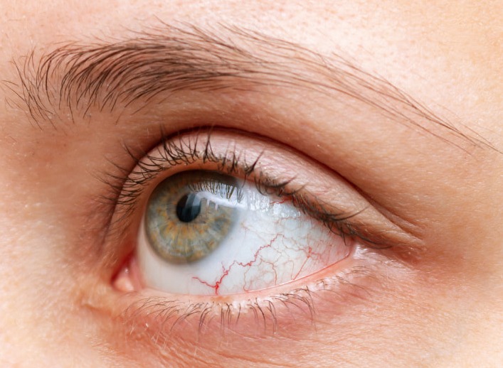 Chronisch entzündliche Darmerkrankungen (CED) und Augenerkrankungen - wie hängen sie zusammen?