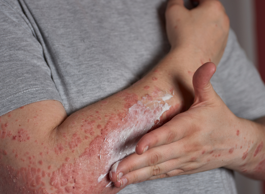 „Meine Psoriasis hat es nie geschafft, ein Visum zu bekommen, um in meinen Kopf einzudringen“